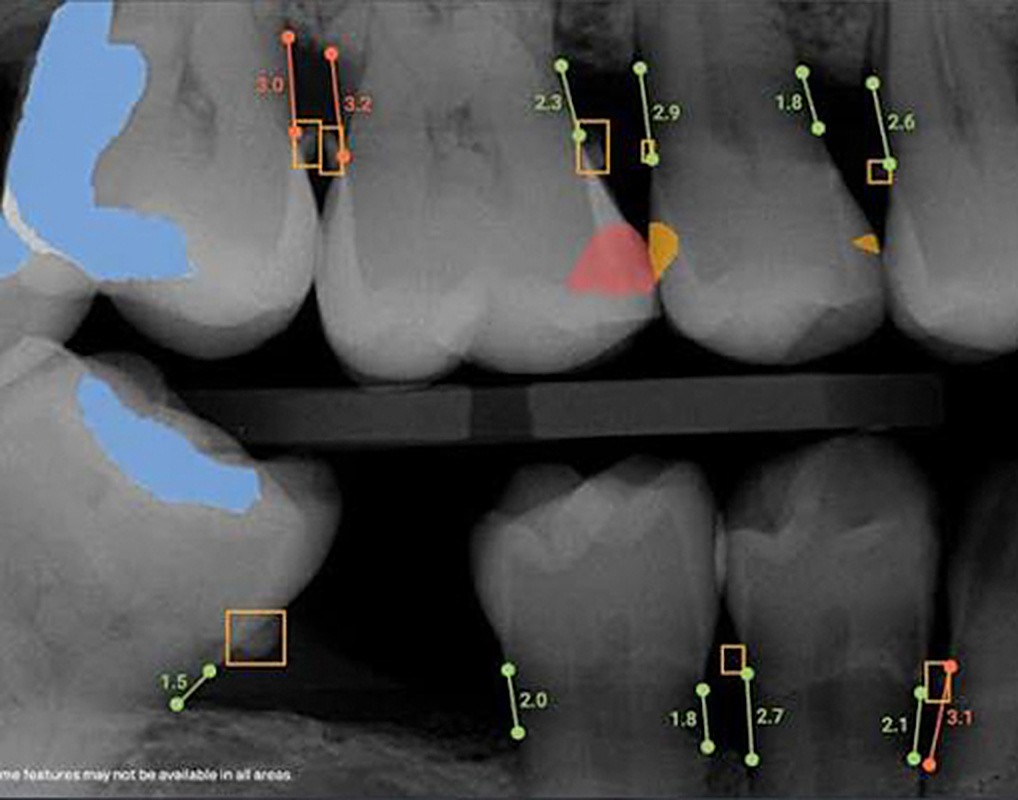 Digital dental X-ray with AI analysis used to plan a tooth extraction at Westside Dental Center in Plantation, FL