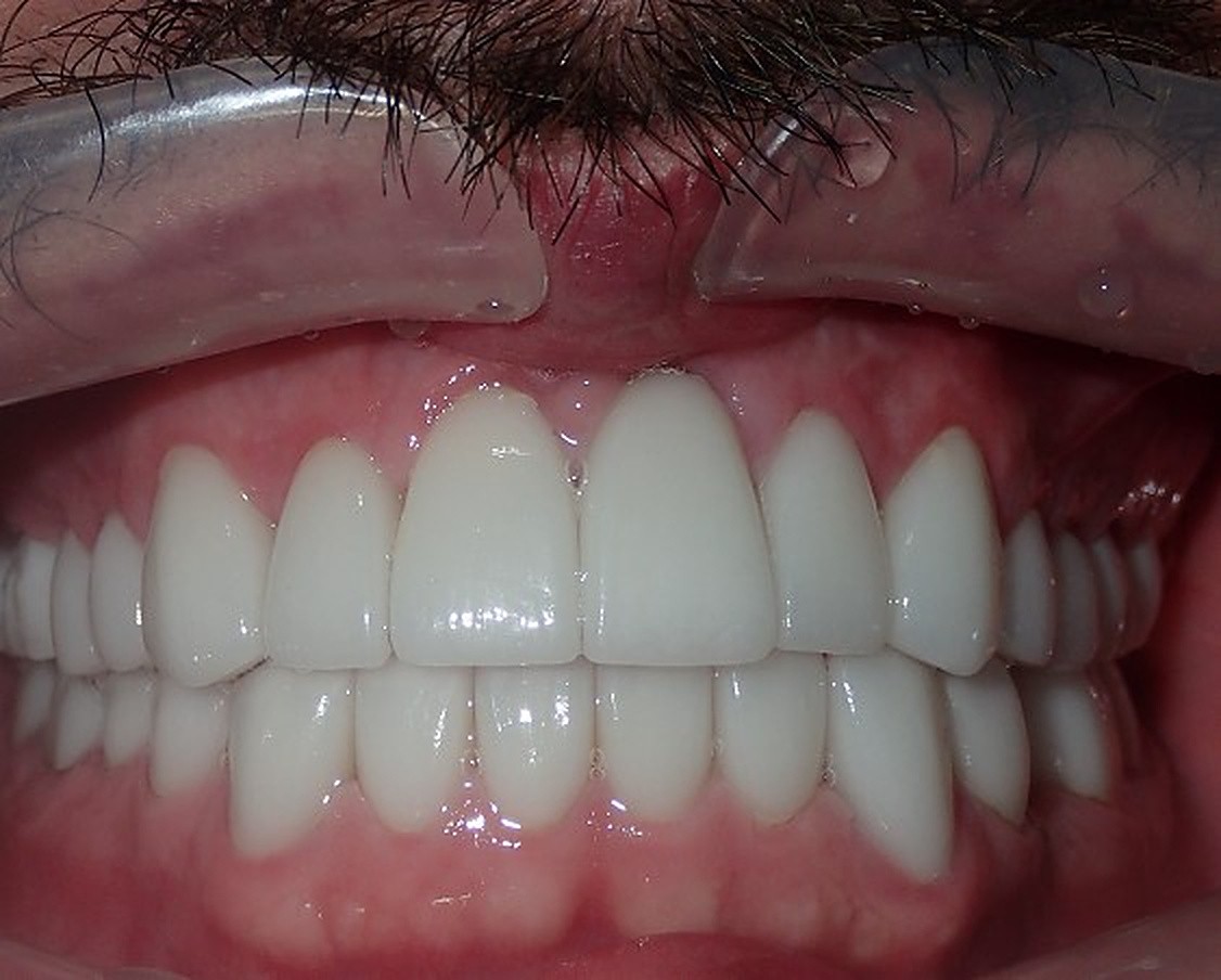 Full Mouth Restoration - after