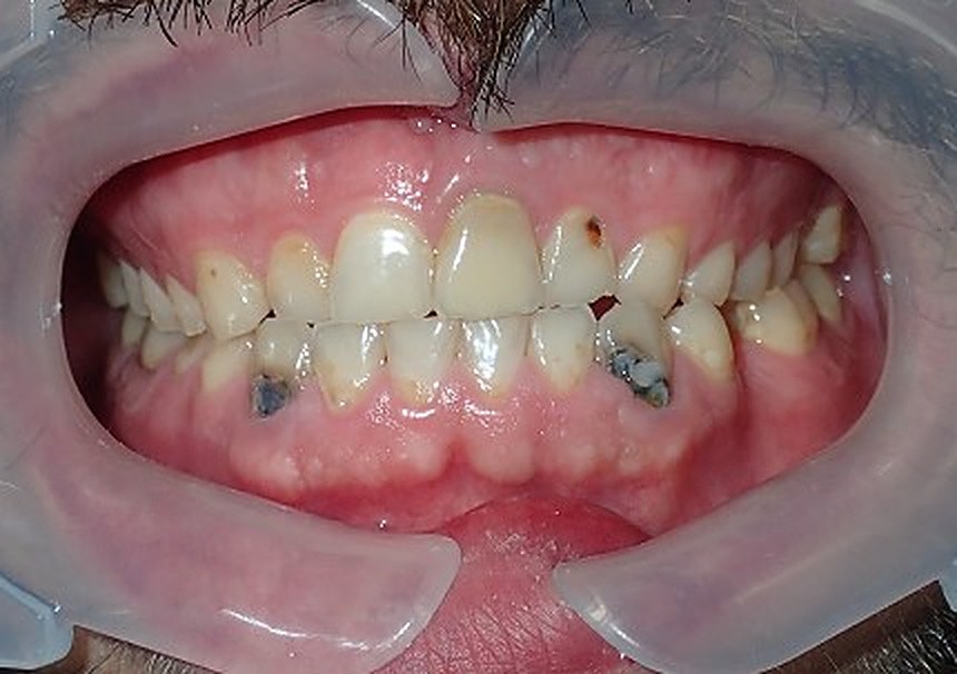 Full Mouth Restoration - before