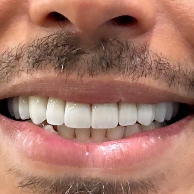 Full Mouth Restoration - after