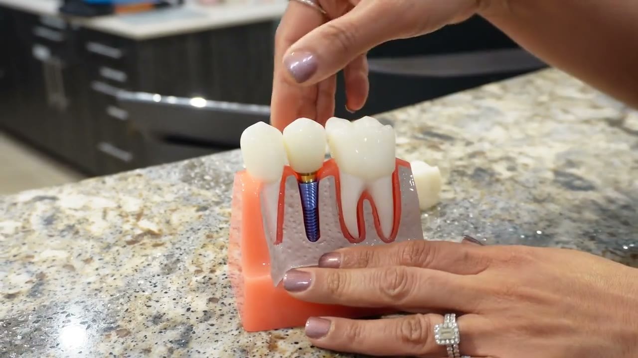 A dental implant model on the front desk counter