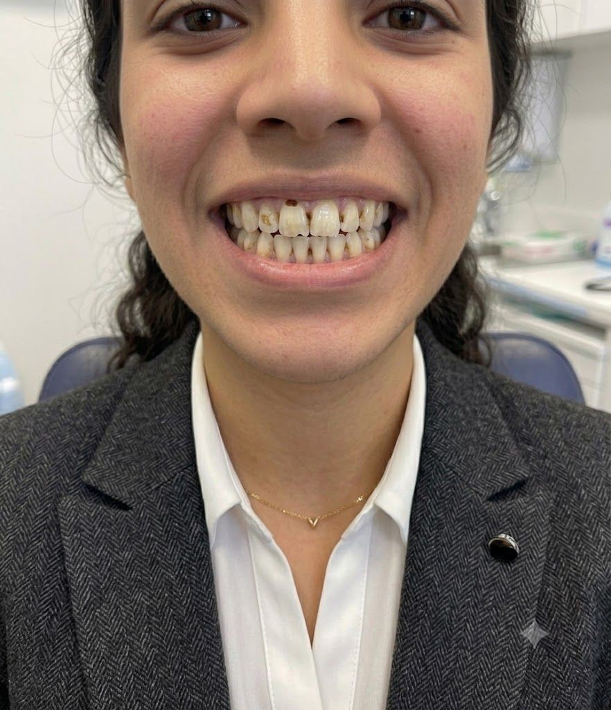 Smile Makeover - before