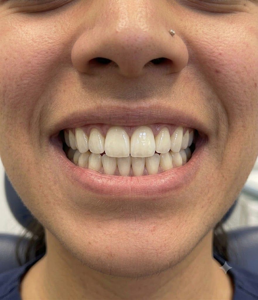 Veneers - after