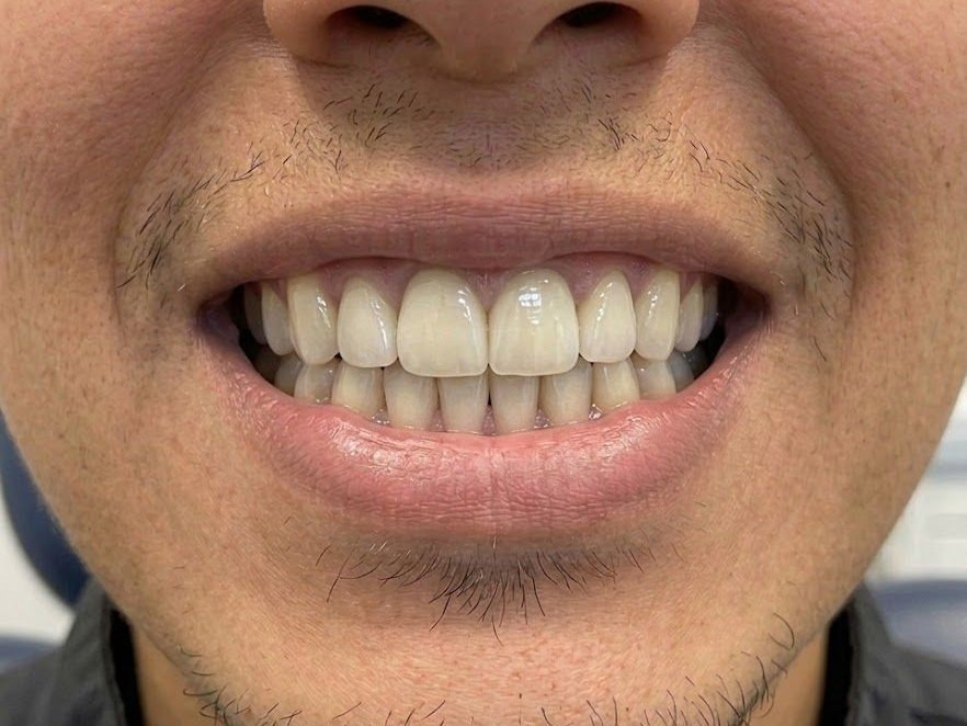 Dental Crown - after
