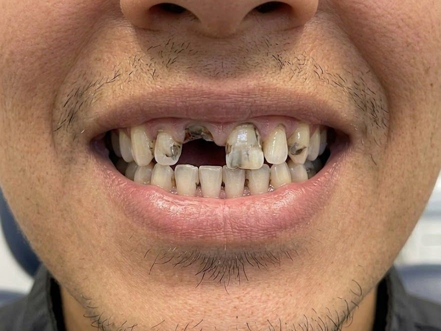 Dental Crown - before