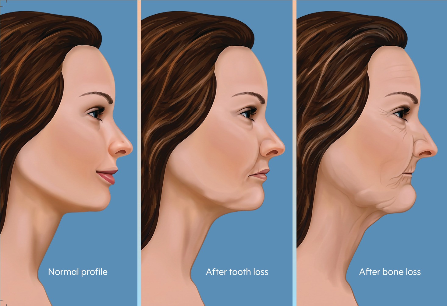 Facial profile: normal, after tooth loss and after bone loss