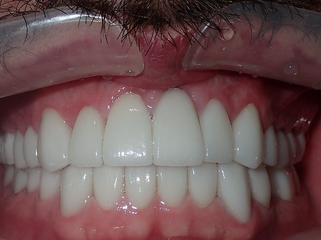 Full Mouth Restoration - after