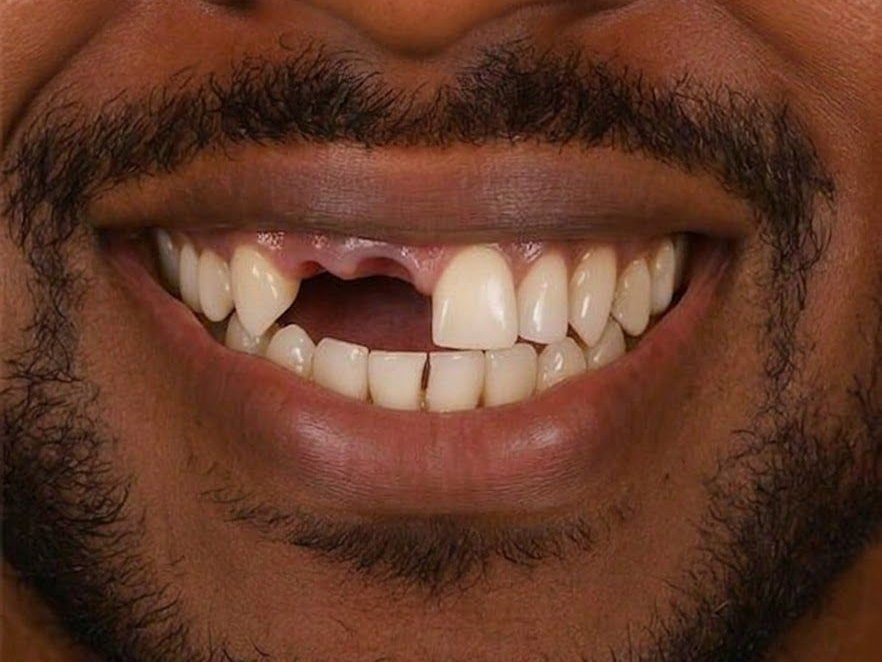 Dental Implants - before