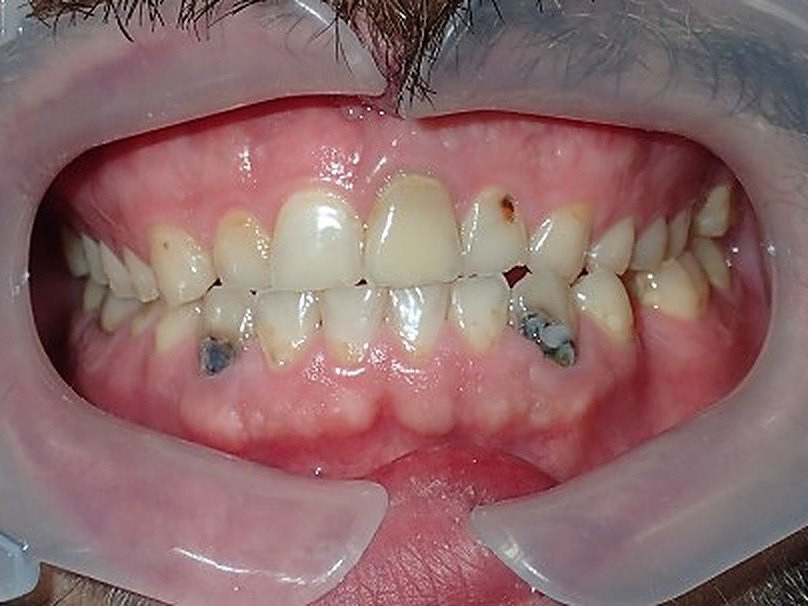 Full Mouth Restoration - before