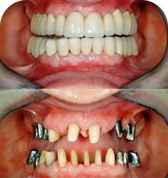 Full-arch All-on-X teeth fixed on dental implants