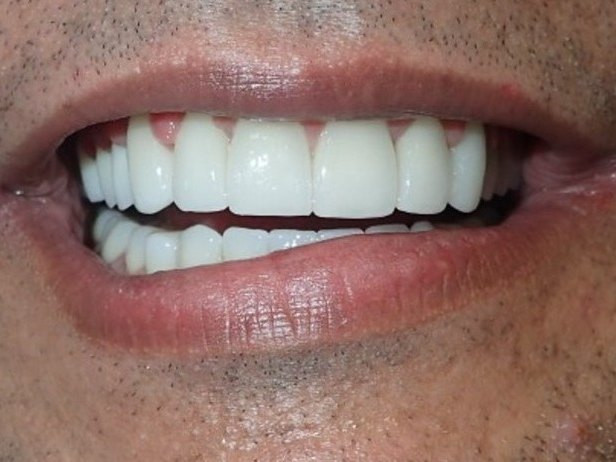 Full Mouth Restoration - after