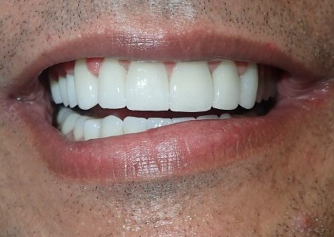 Full Mouth Restoration - after
