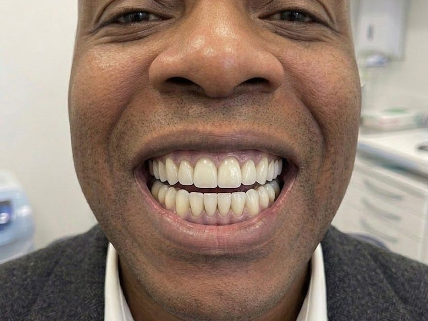 Full Mouth Restoration - after