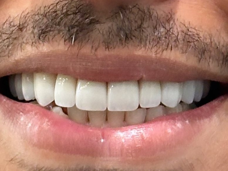 Full Mouth Restoration - after