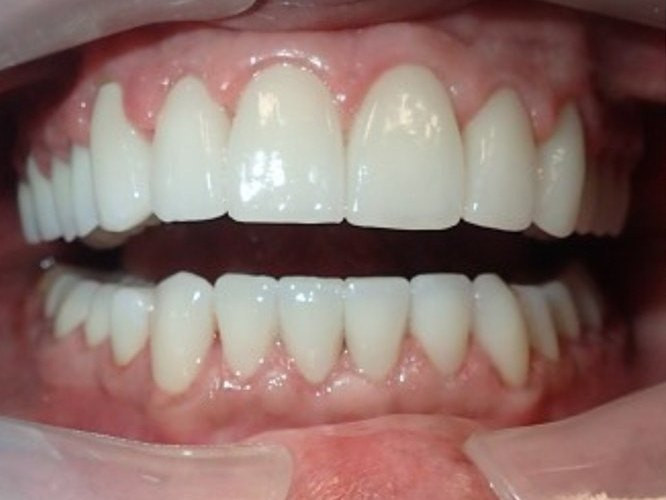 Full Mouth Restoration - after