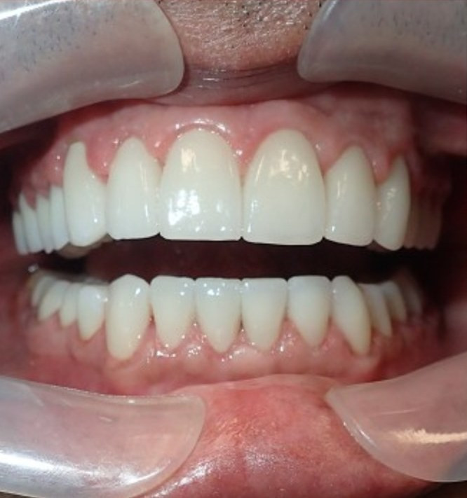 Full Mouth Restoration - after