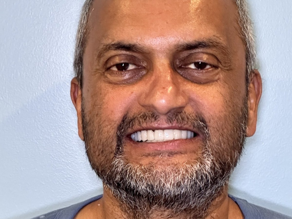 Full Mouth Restoration - after