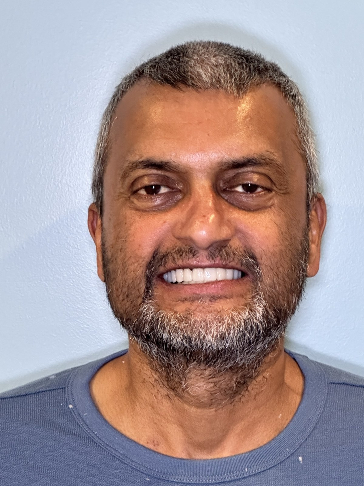 Full Mouth Restoration - after