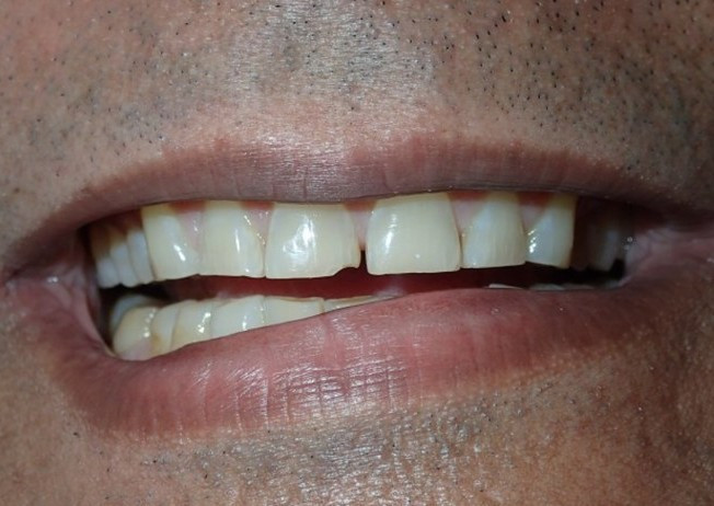 Full Mouth Restoration - before