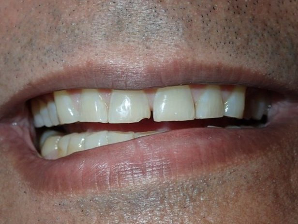 Full Mouth Restoration - before