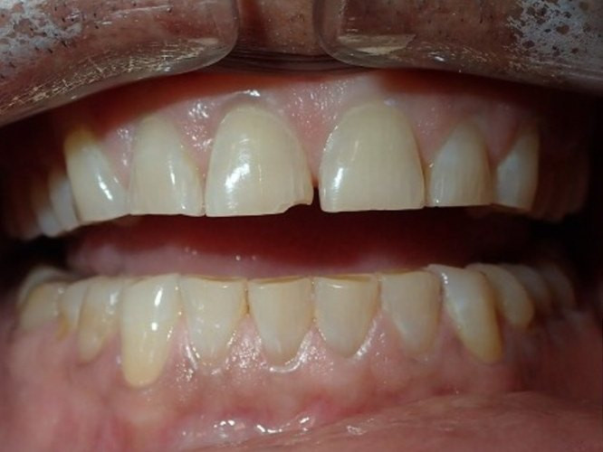 Full Mouth Restoration - before