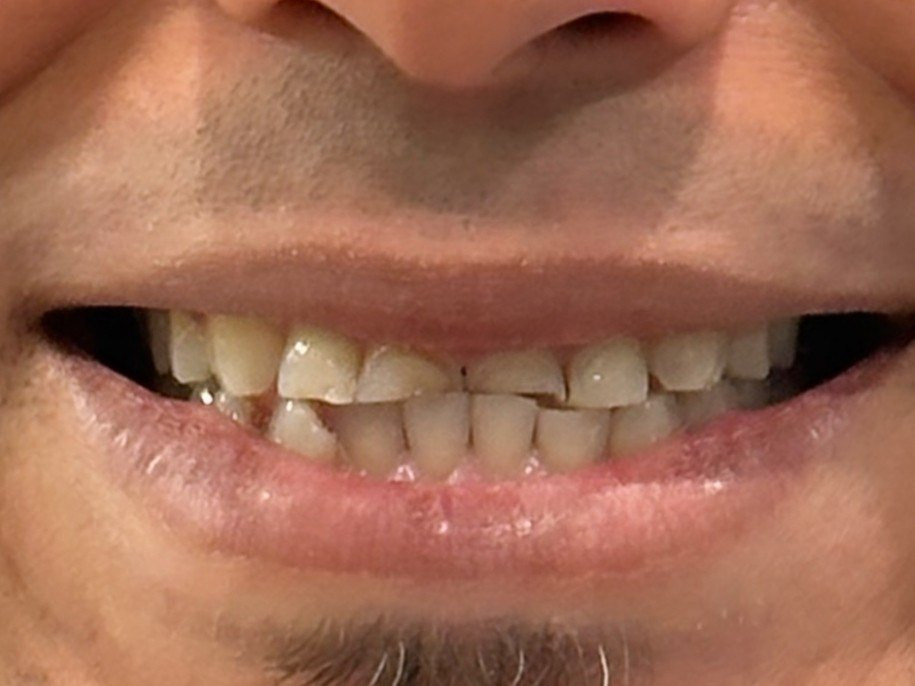 Full Mouth Restoration - before