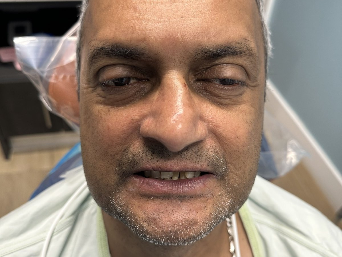 Full Mouth Restoration - before