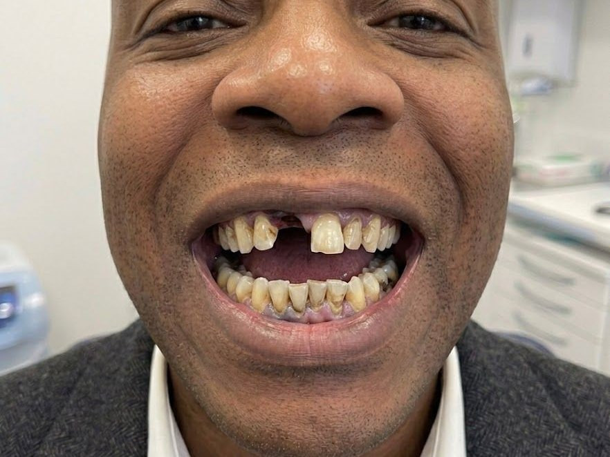 Full Mouth Restoration - before