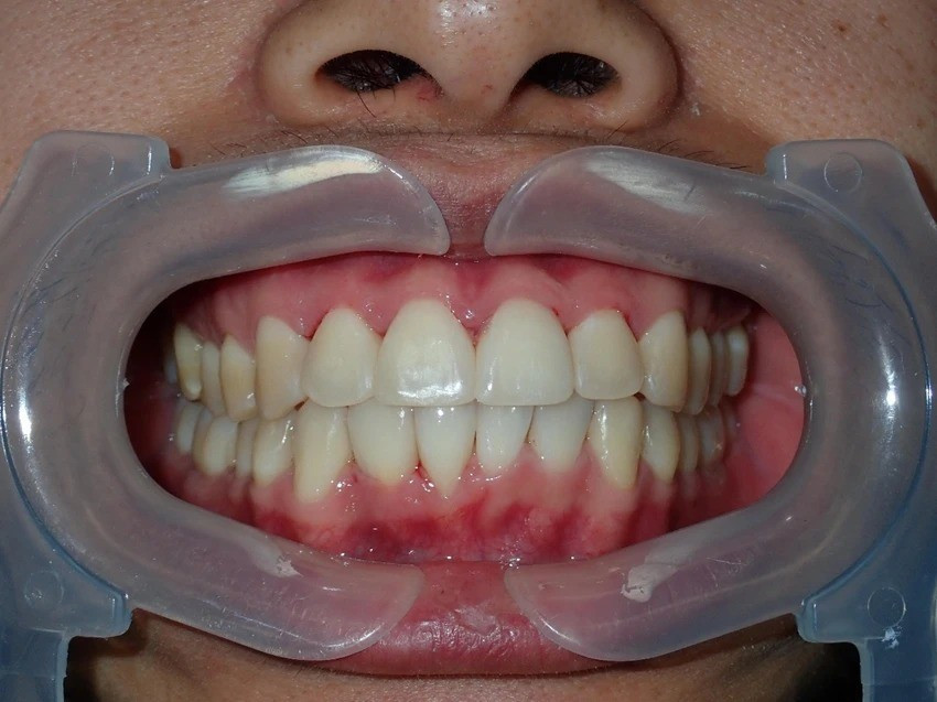 Invisalign - after