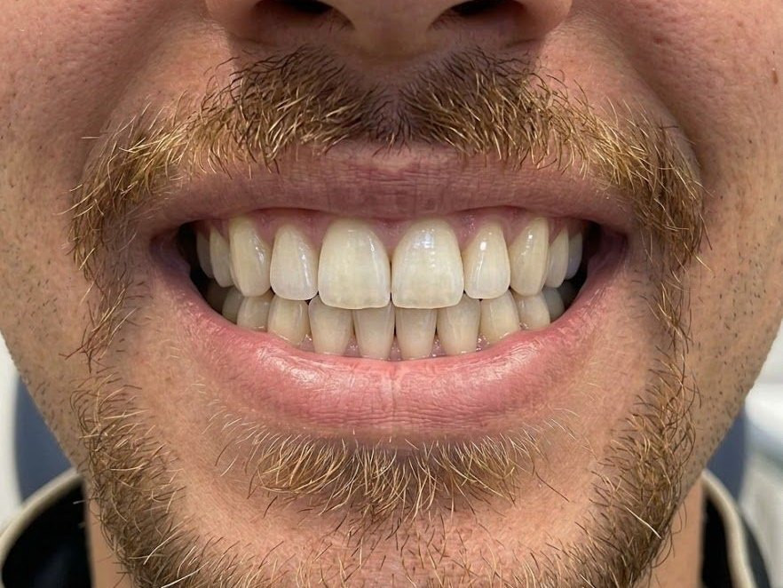 Invisalign - after