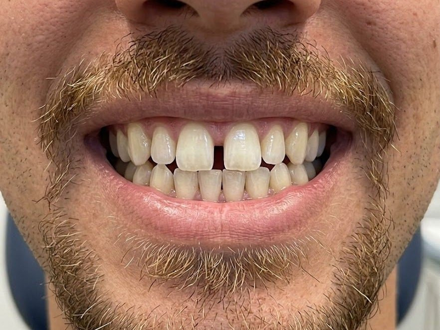 Invisalign - before