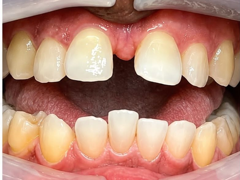 Invisalign - before