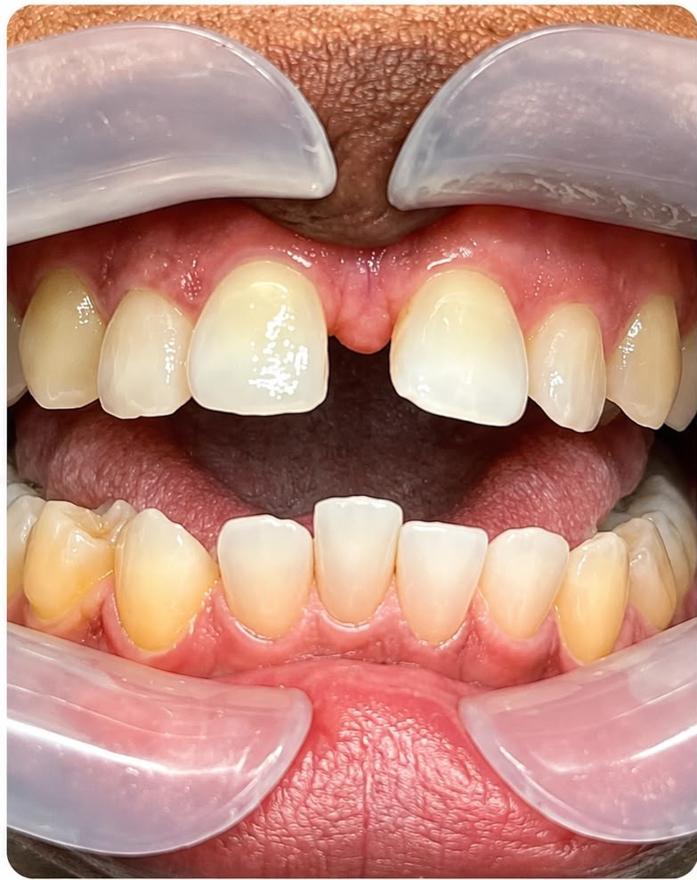 Invisalign - before