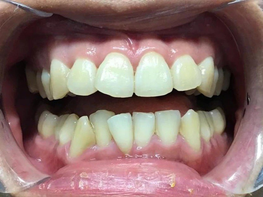 Invisalign - before