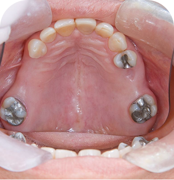 Implants placed to replace several missing teeth