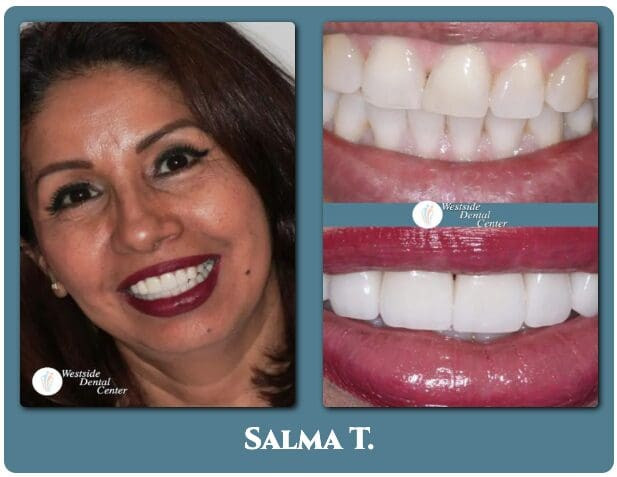 Porcelain veneers before and after for a Westside Dental Center patient in Plantation, FL