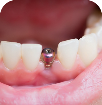 Single dental implant replacing one missing tooth