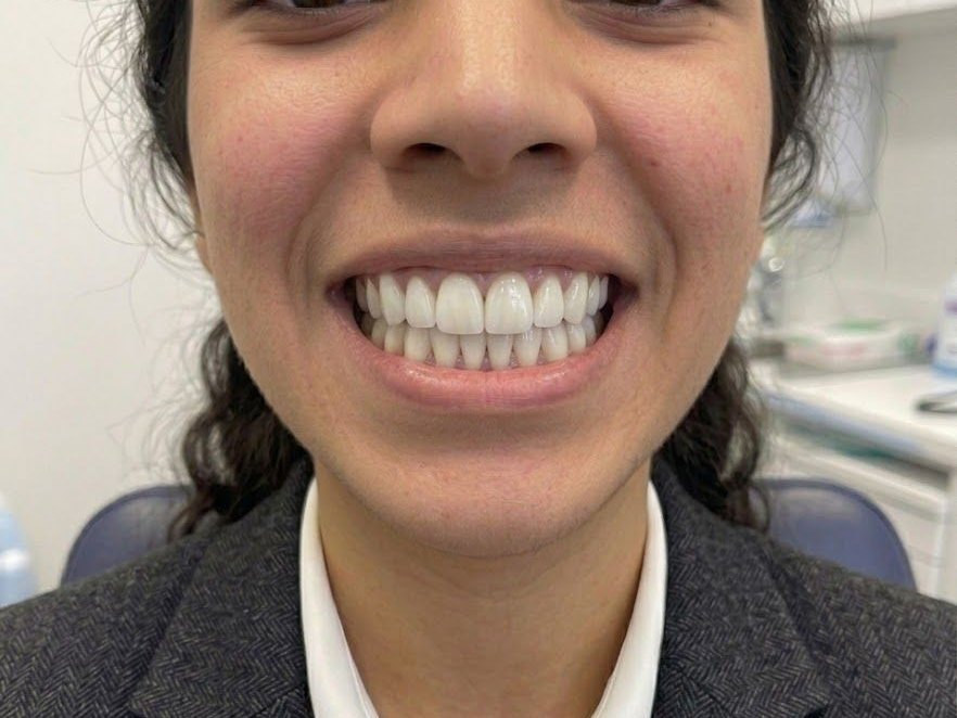 Smile Makeover - after
