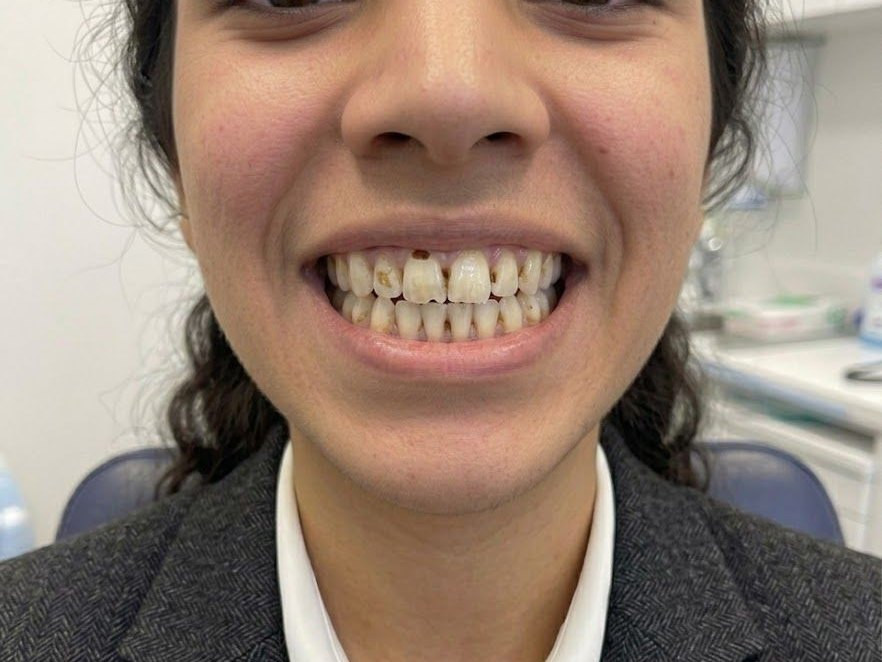 Smile Makeover - before