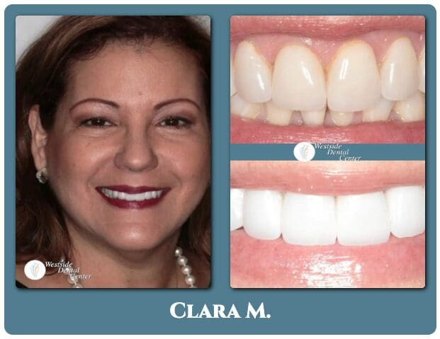 Teeth whitening before and after for a Westside Dental Center patient in Plantation, FL