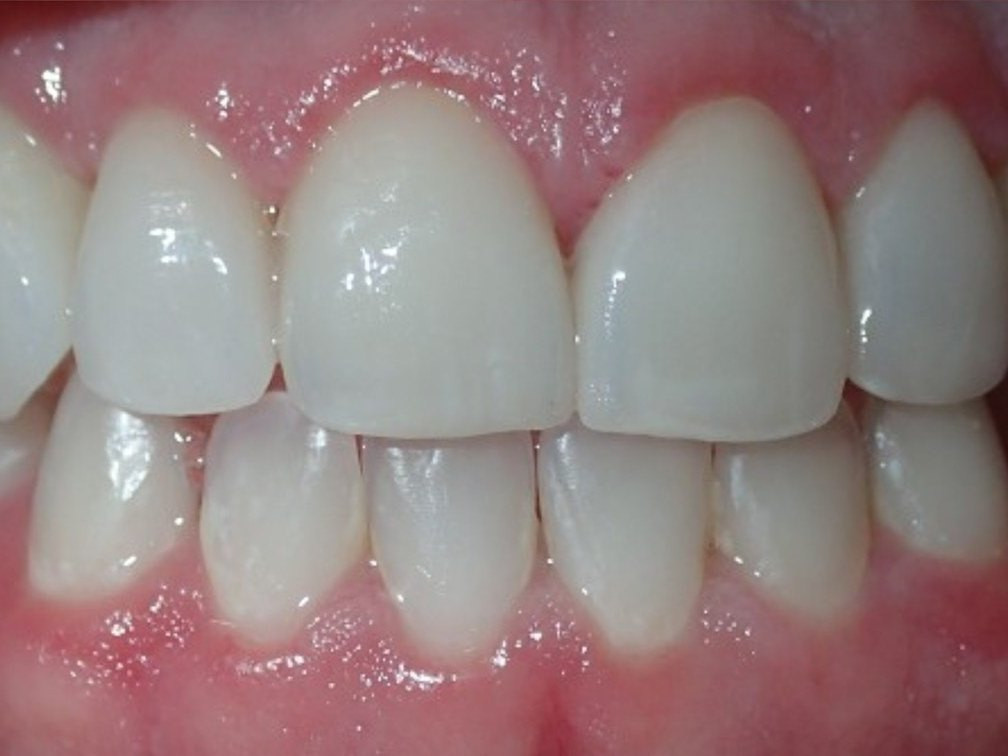 Veneers - after