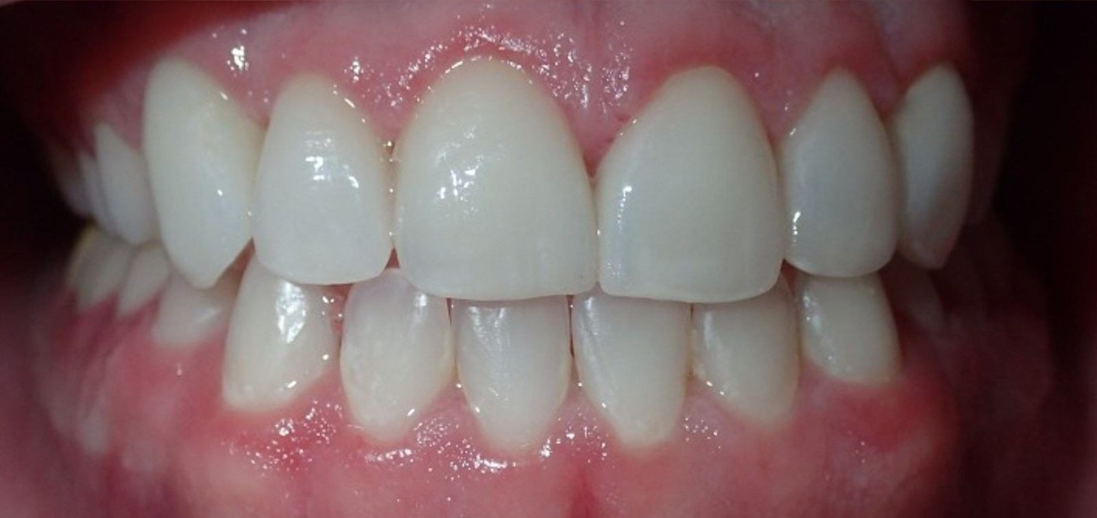 Veneers - after