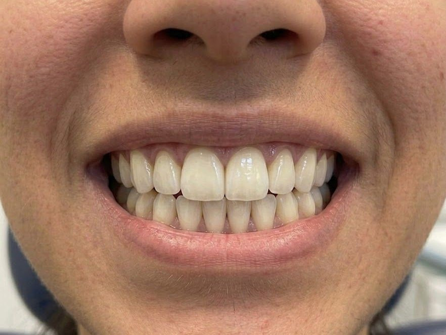 Veneers - after