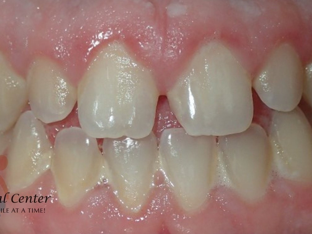 Veneers - before