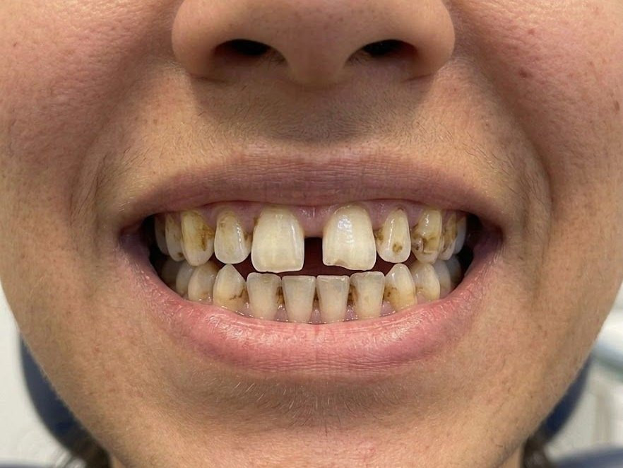 Veneers - before