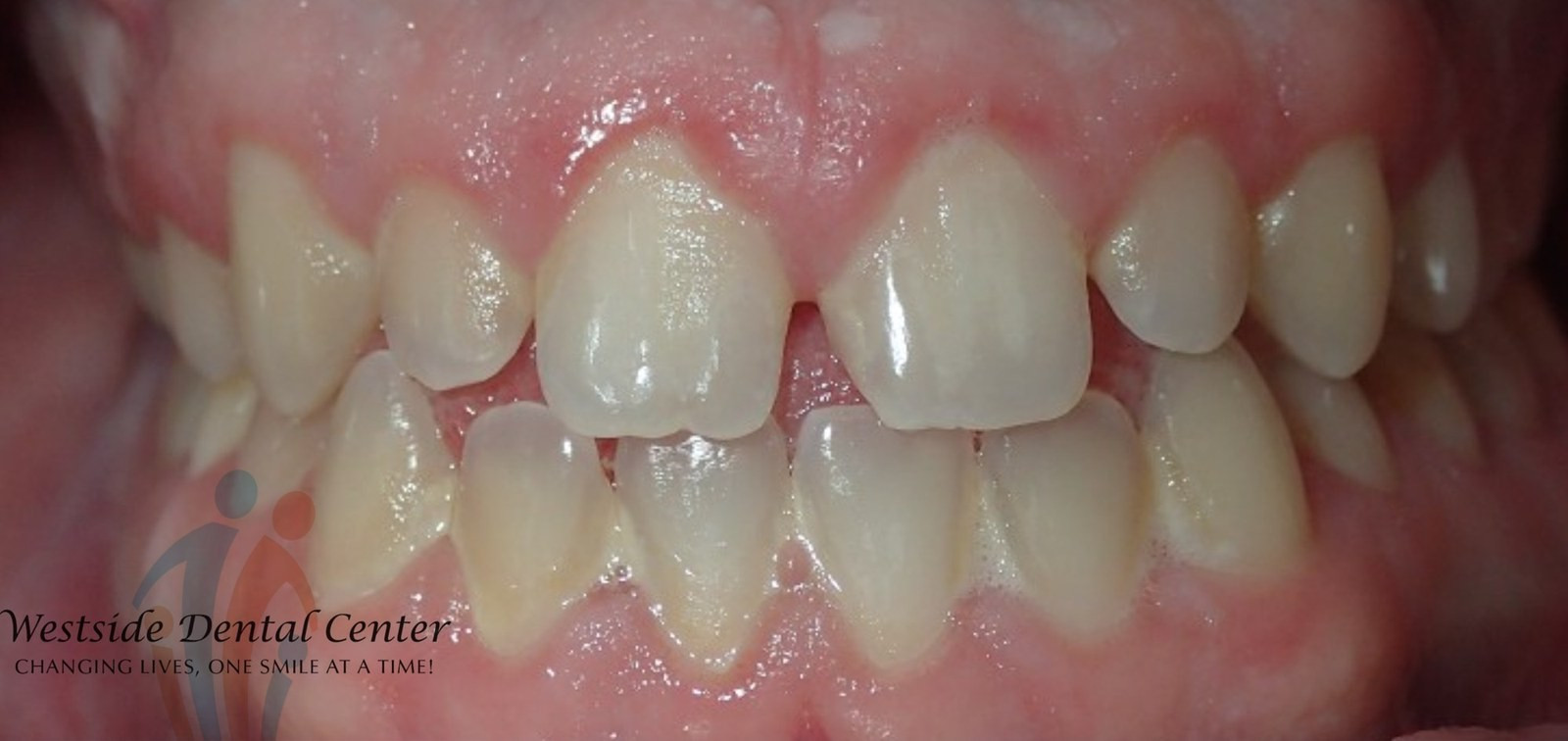Porcelain veneers - before
