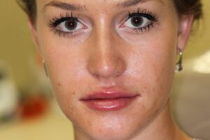 facial Botox treatment in Plantation FL