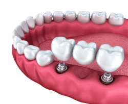 dental bridge secured by dental implants by Plantation FL dentist
