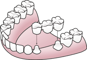 Dental bridge anchored to adjacent teeth