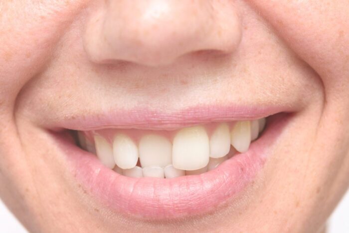 crooked teeth treatment near me